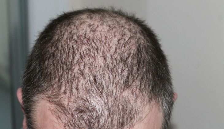 Why Do Men Lose Their Hair? Major Cause of Baldness and Tips to Get Thick Hair