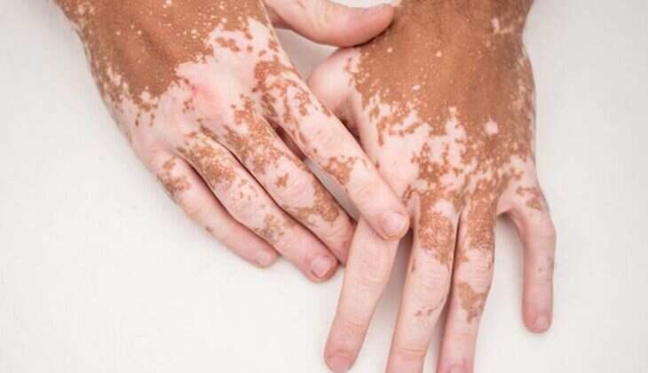 How Vitiligo Starts: Early Symptoms, Triggers & Warning Signs