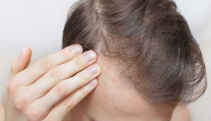 Hair loss in men tips
