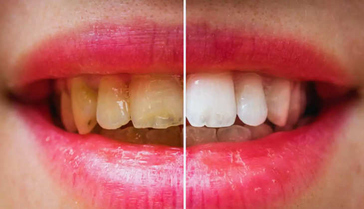 Teeth Whitening Home Remedies: पीली परत होगी दांतों से साफ, मोती जैसे चमकेंगे दांत,अभी लाए ये 4 चीजें