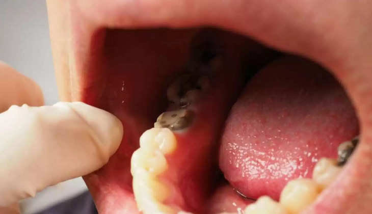 Cavity In Teeth:  क्या दांतों की सड़न के कारण आपको अपना मुंह बंद रखना पड़ता है? जानिए कैसे पाएं 'कैविटी फ्री स्माइल'